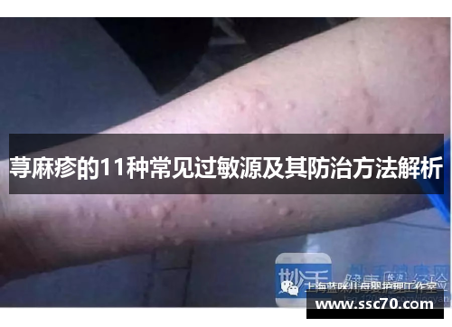 荨麻疹的11种常见过敏源及其防治方法解析